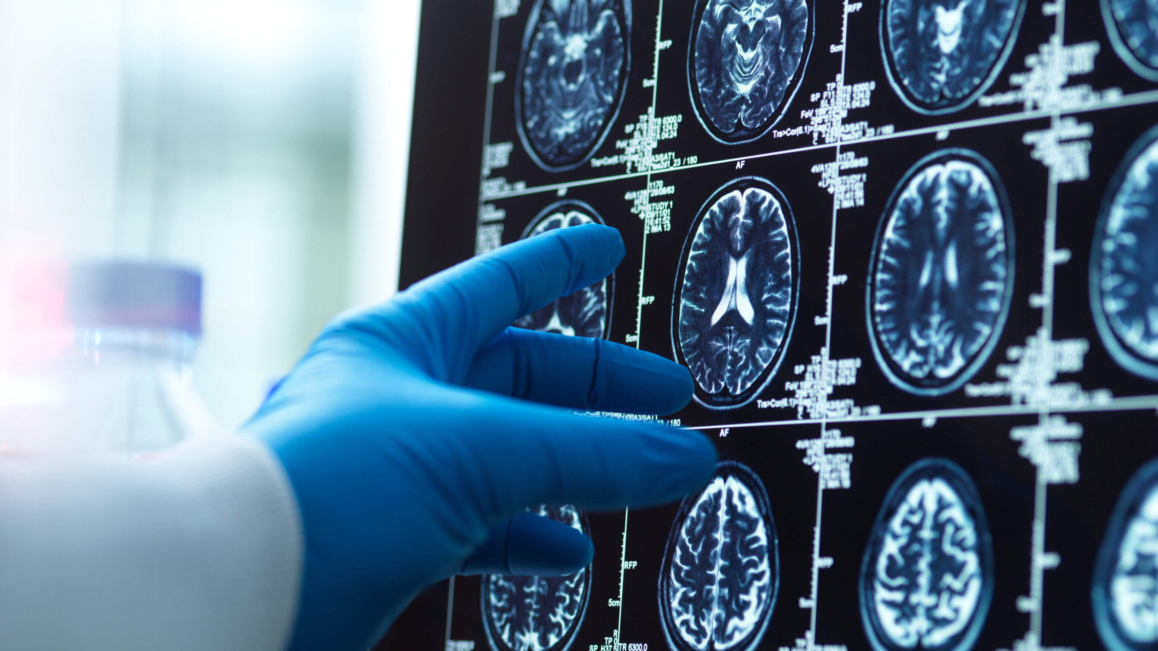 The high-fat diet that could protect an ageing brain from Alzheimer’s