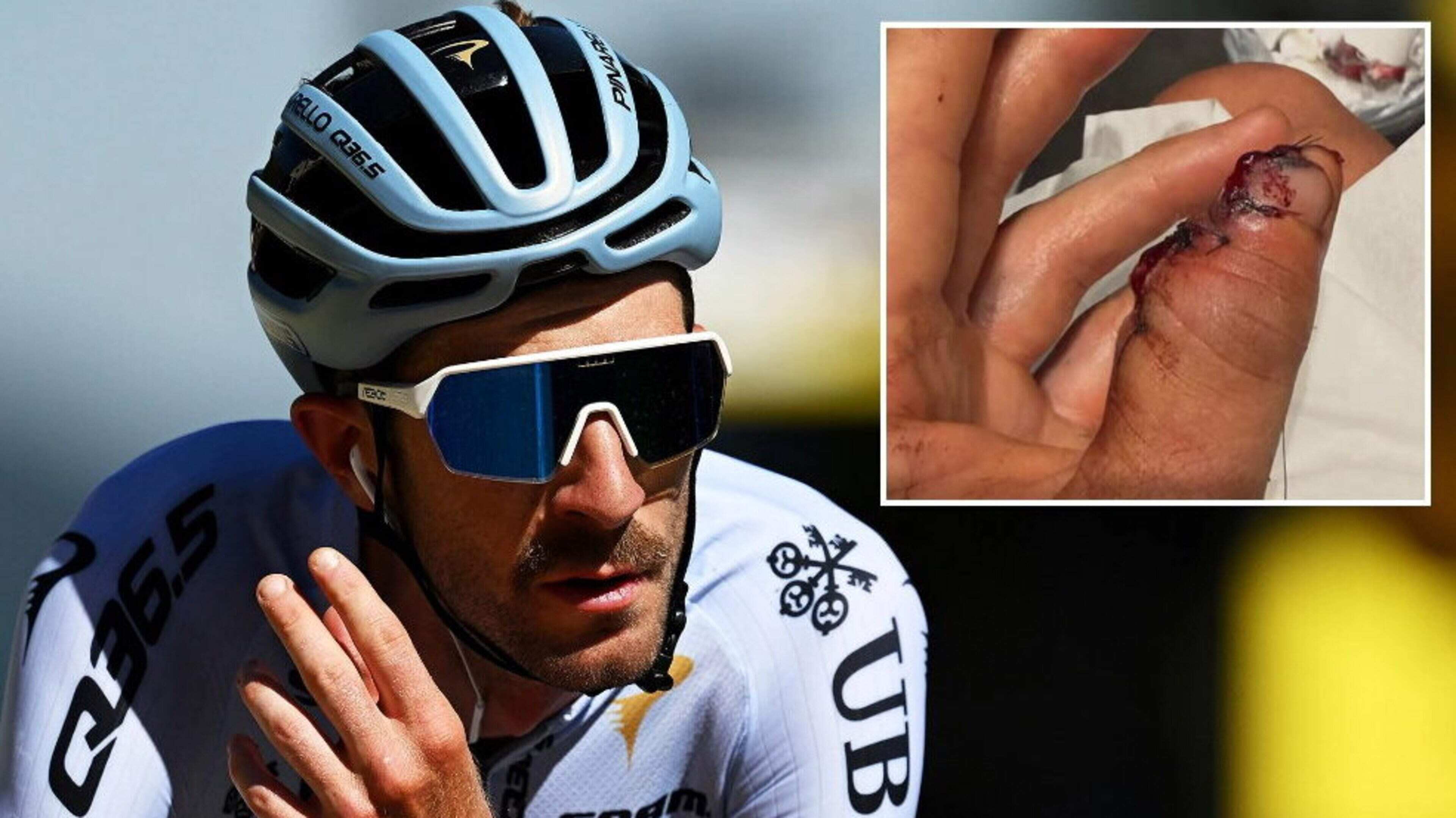 ‘Fingers crossed for a quick recovery’ — Cyclist pulls out of Tour de France after losing part of his thumb