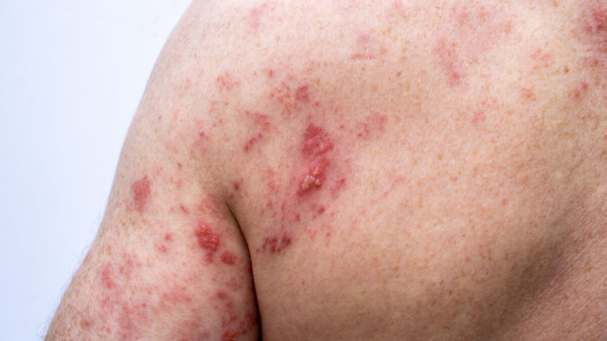 Cost of Shingles jab at 500 leaves pensioners facing 'eating or heating choice'