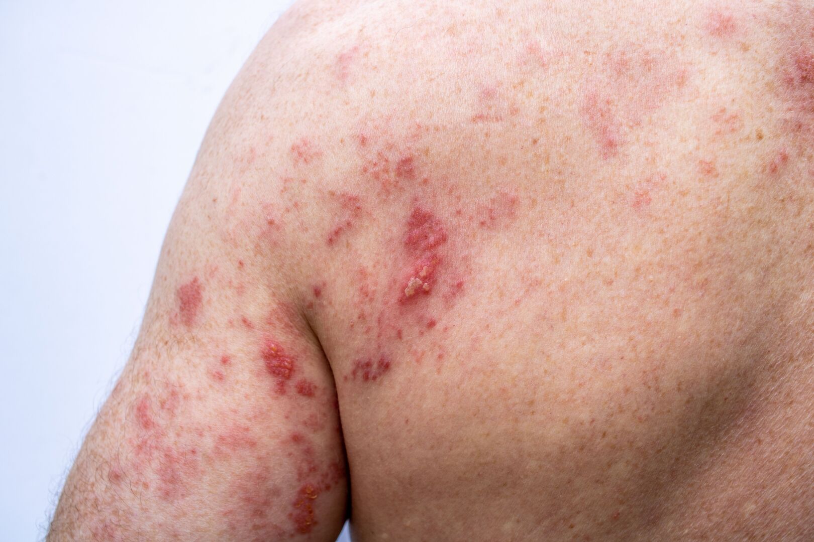 Cost of Shingles jab at €500 leaves pensioners facing ‘eating or ...