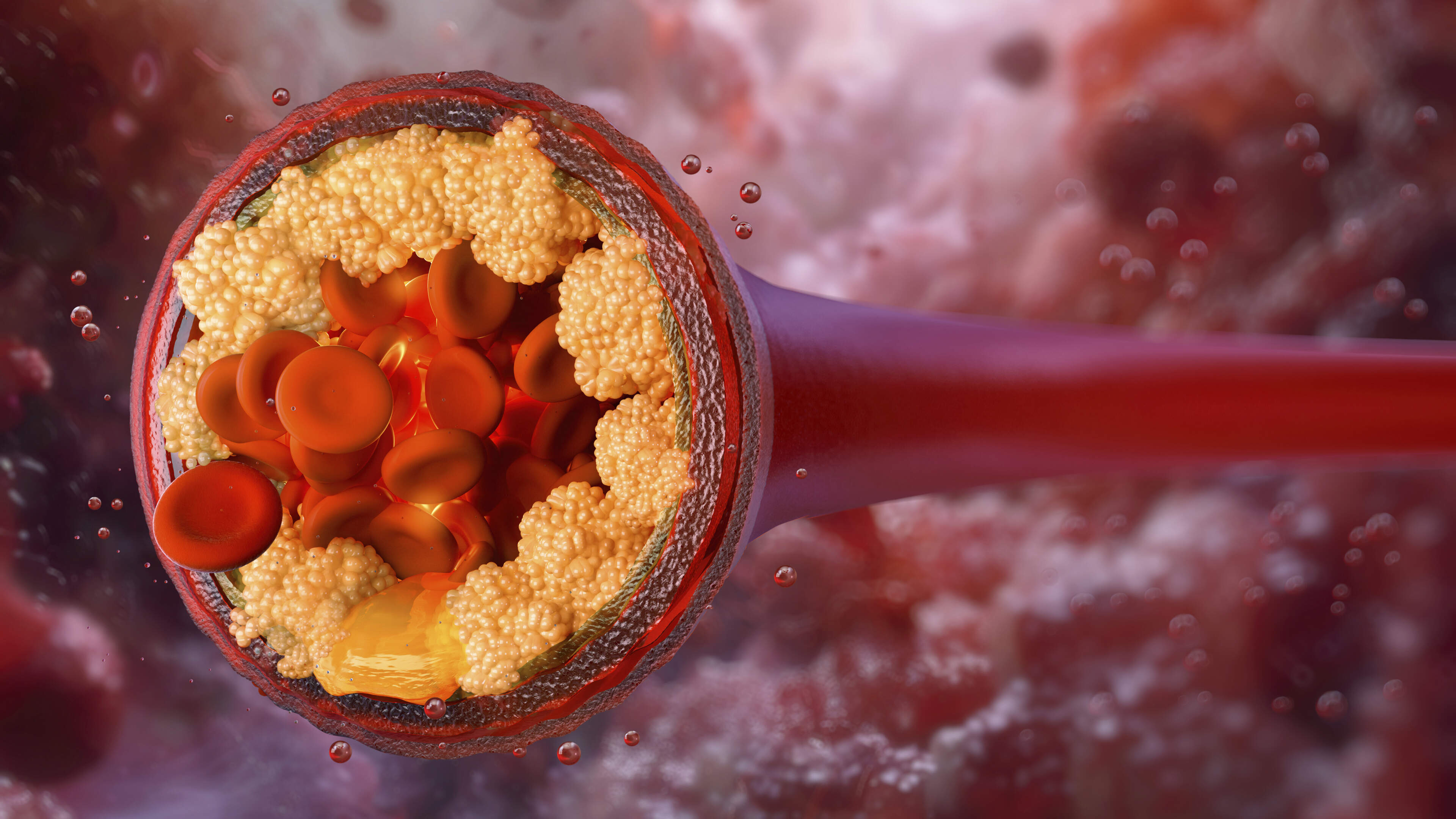 Single injection trial shows large reduction in ‘bad’ cholesterol levels