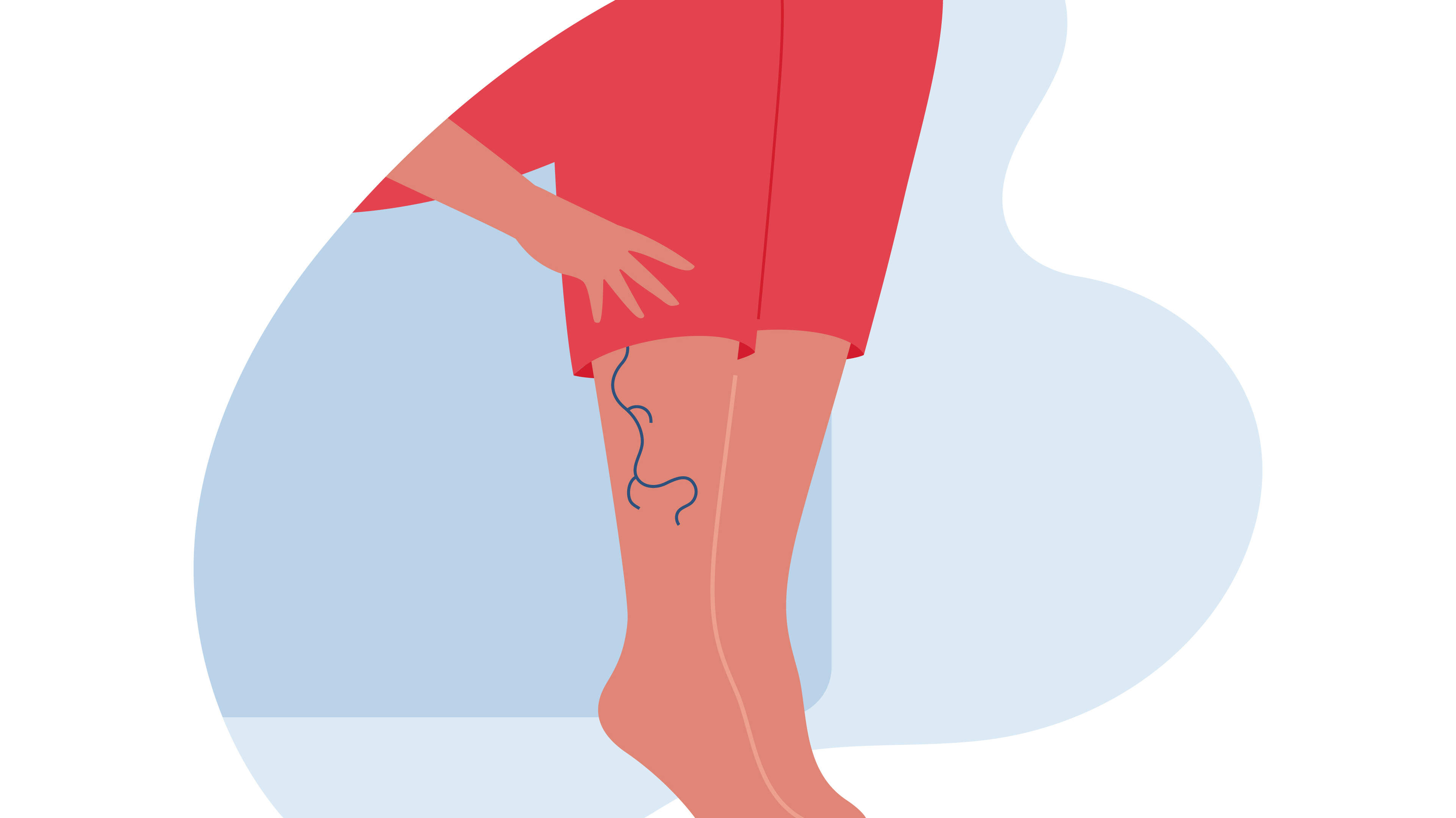 Stay Well: Recently I’ve noticed a few varicose veins on my legs. How do I get rid of them and stop more developing? 