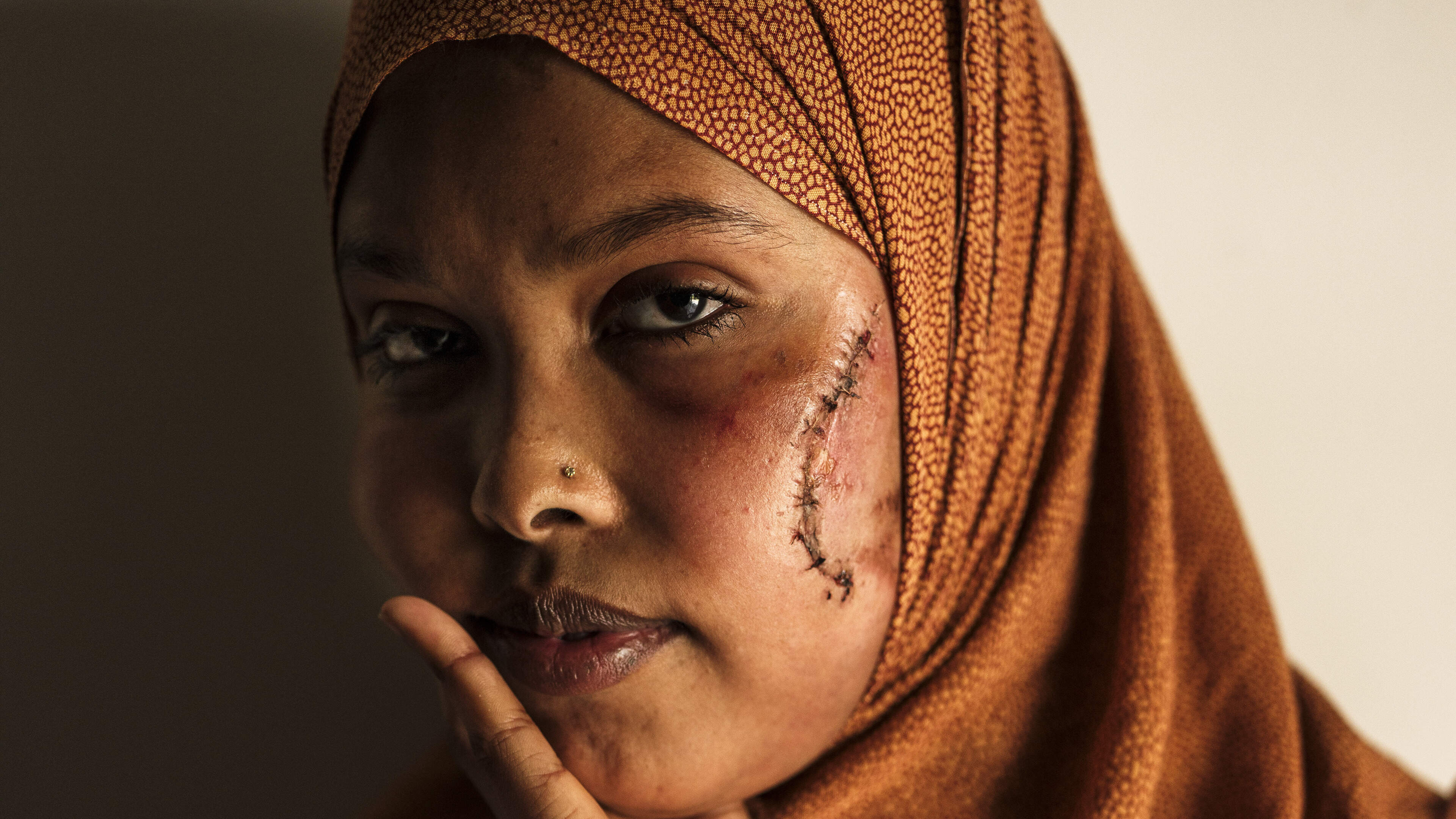 ‘I can’t accept what I see in the mirror’ – woman left with facial scars after alleged attack on O’Connell Street