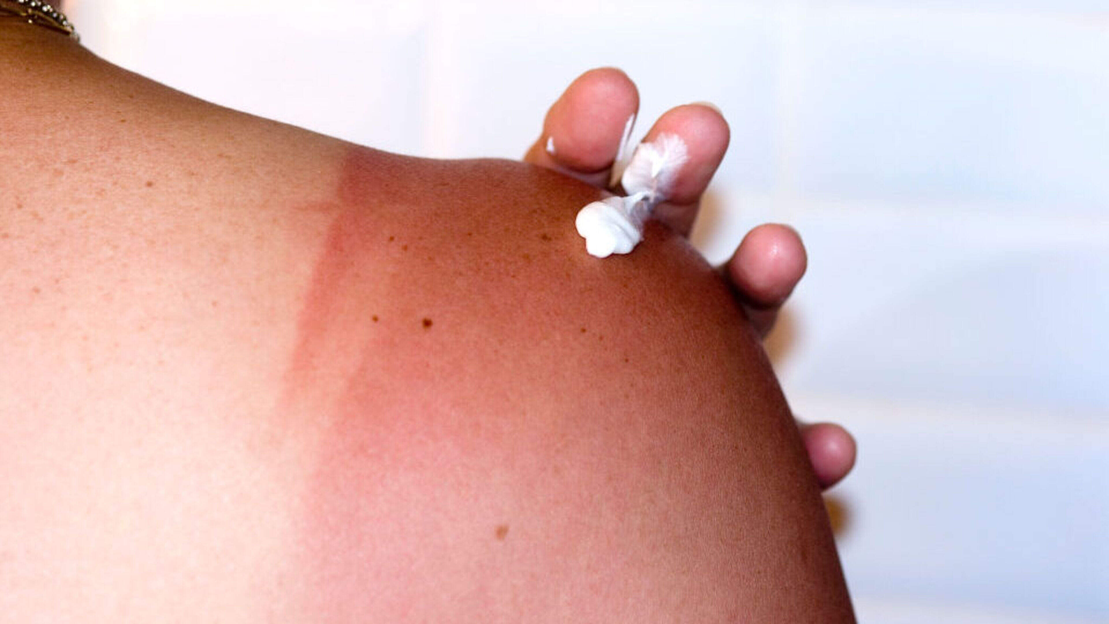 Máire Treasa Ní Cheallaigh: TikTok sunscreen myths are putting Irish skin at risk