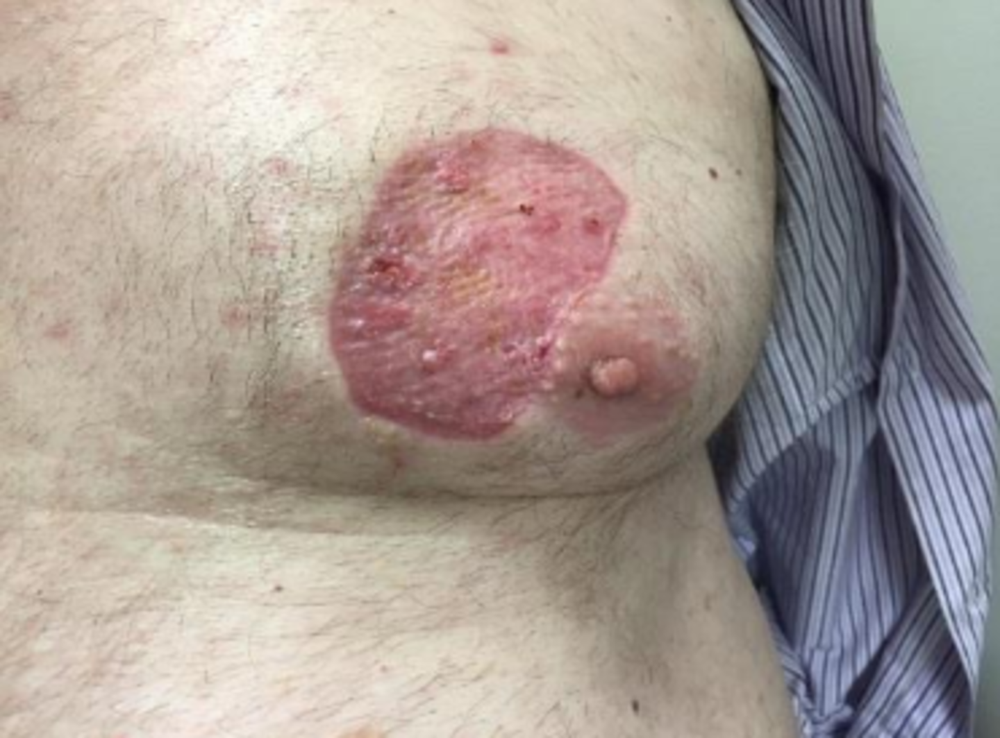 cigarette throat cancer 🚭 Quit Smoking While You Can 🚭 Former smoker Tony, diagnosed with throat  cancer at just 52, had to learn to talk again. His message: “Get help and  support and just get