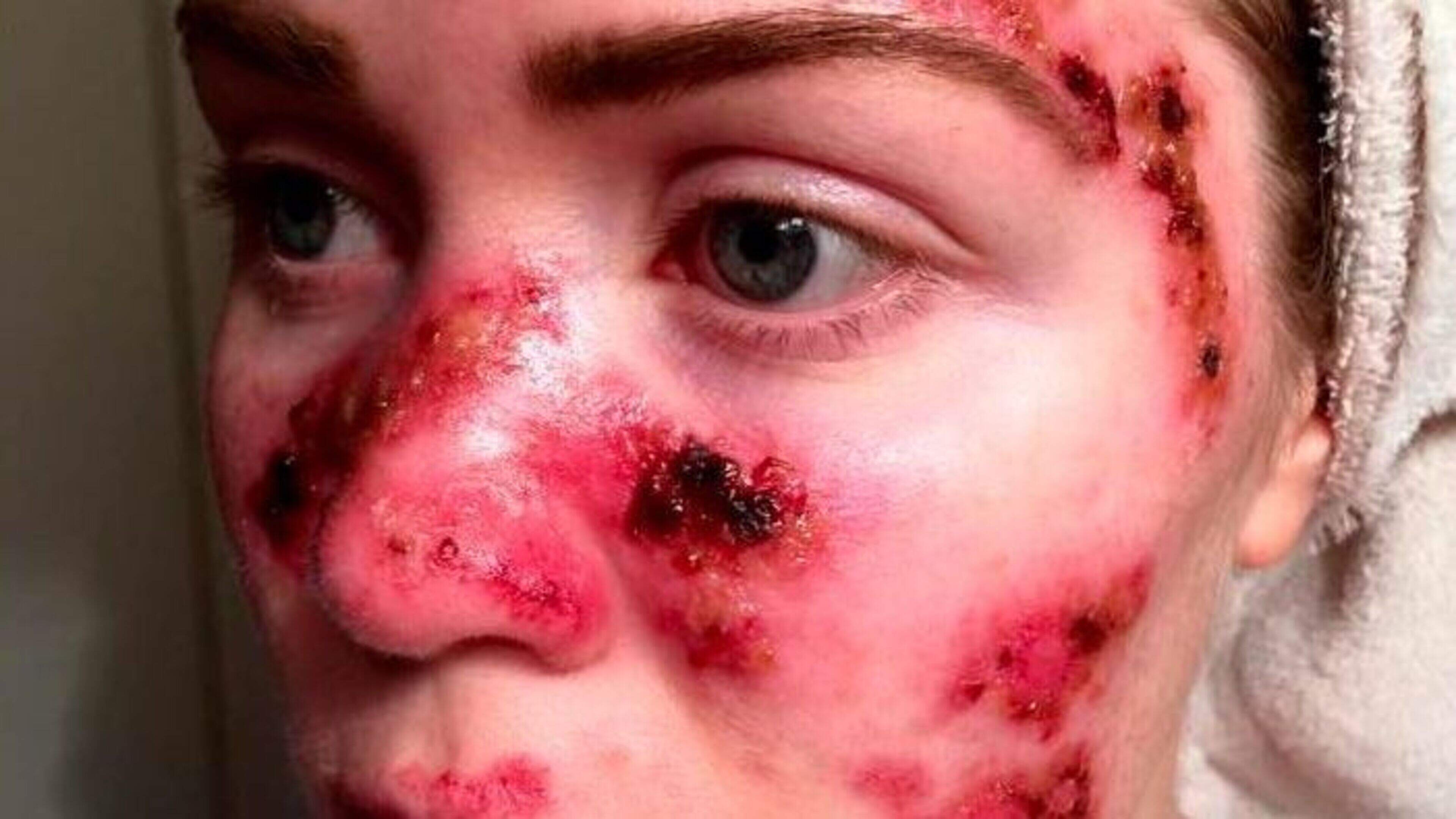 Fears of skin cancer surge after heatwave-related sunburns